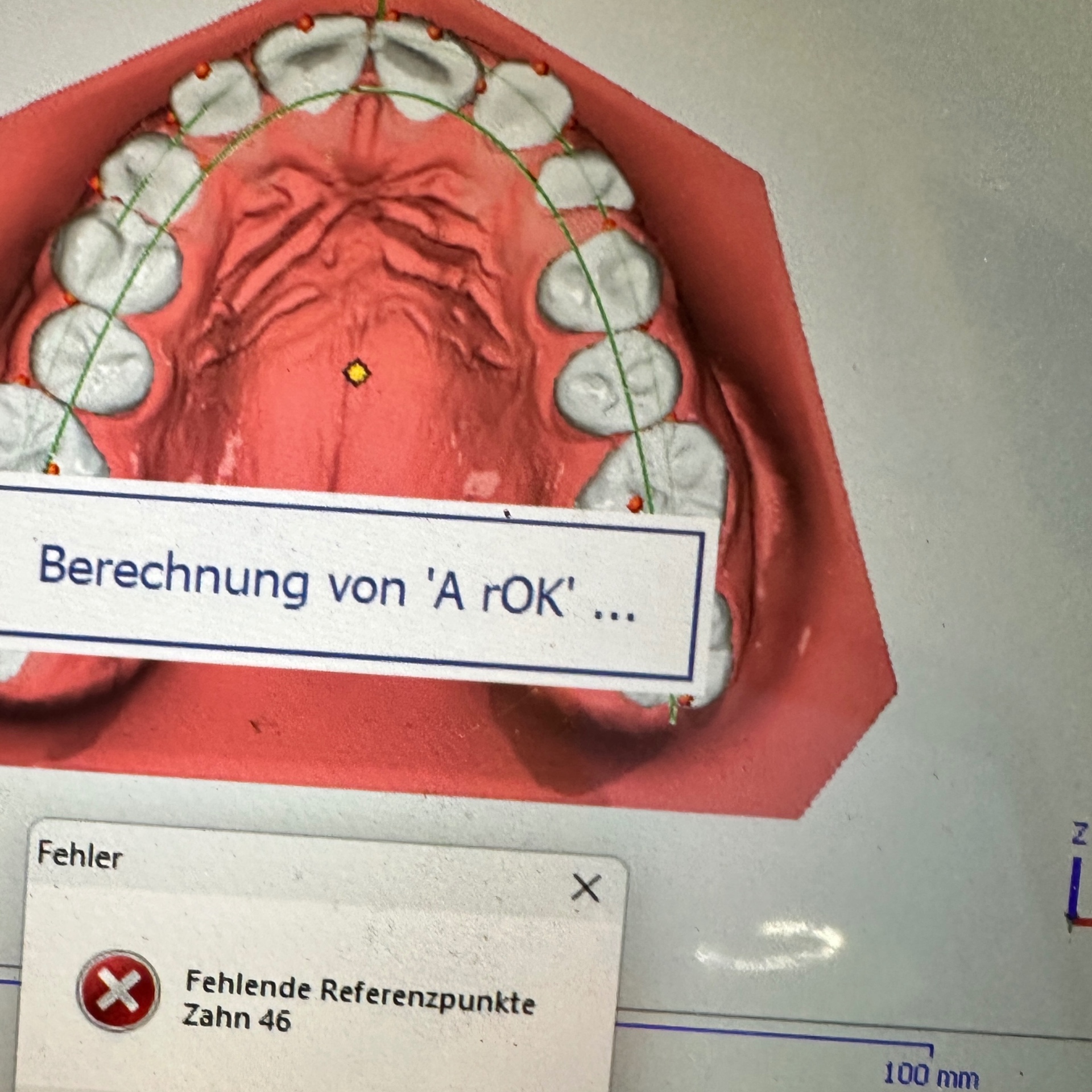 Digitale Fallplanung – Berechnung am Oberkiefermodell